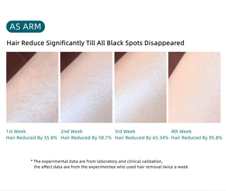 Photoépilateur Laser électrique indolore